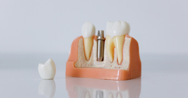 Smile Care: המדריך לבחירת השתלים הבטוחים והעמידים ביותר